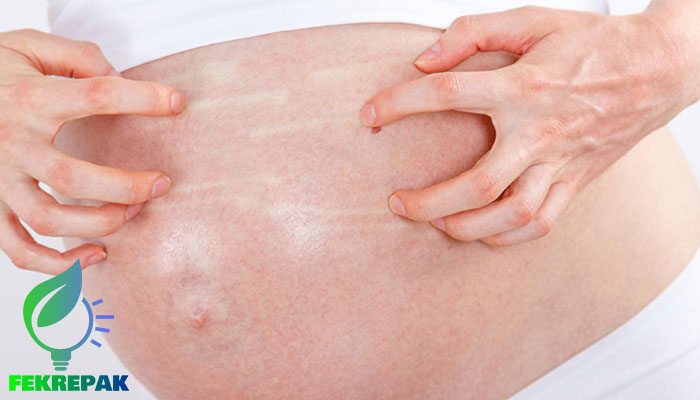 تغییرات پوست در دوران بارداری